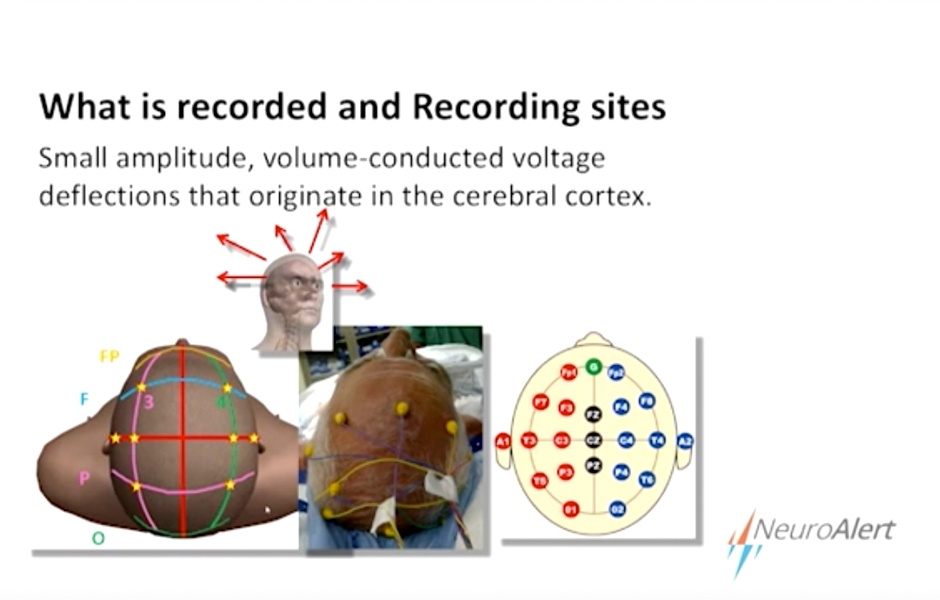 Chris Martin Speaks at TxANA EEGs and SSEPs Neuro Alert
