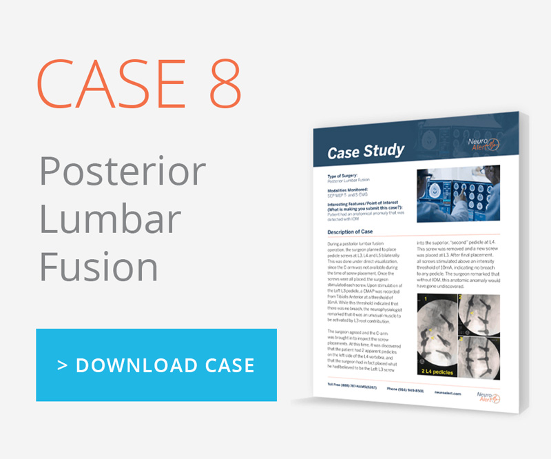 Case Study: Posterior Lumbar Fusion